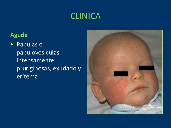 CLINICA Aguda • Pápulas o pápulovesículas intensamente pruriginosas, exudado y eritema 