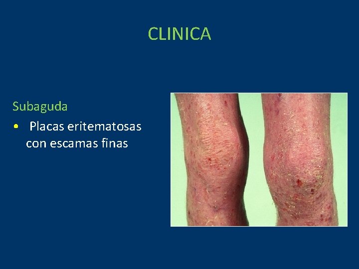 CLINICA Subaguda • Placas eritematosas con escamas finas 