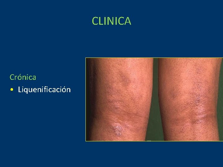 CLINICA Crónica • Liquenificación 