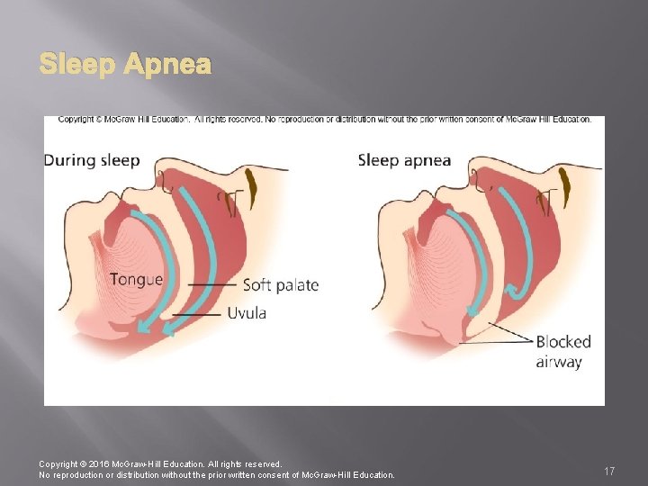 Sleep Apnea Copyright © 2016 Mc. Graw-Hill Education. All rights reserved. No reproduction or