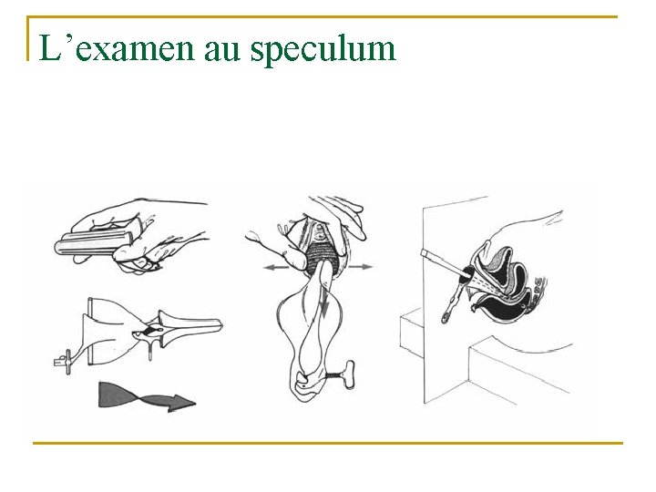 L’examen au speculum 