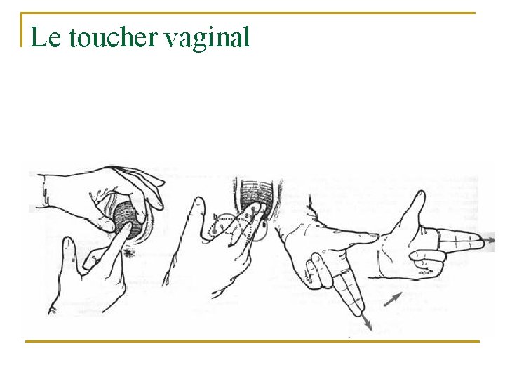Le toucher vaginal 