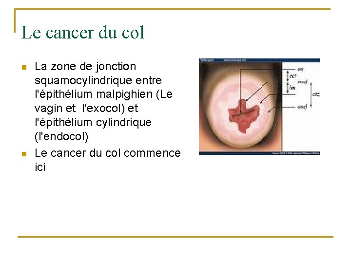 Le cancer du col n n La zone de jonction squamocylindrique entre l'épithélium malpighien