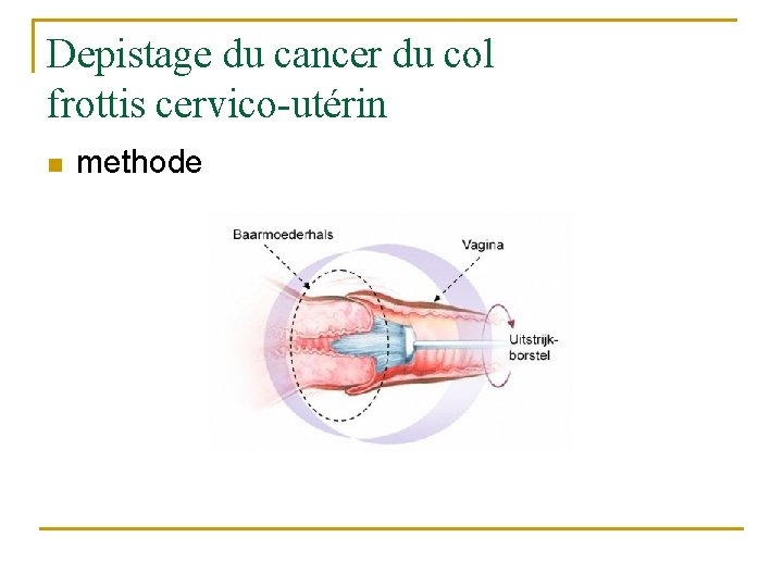 Depistage du cancer du col frottis cervico-utérin n methode 