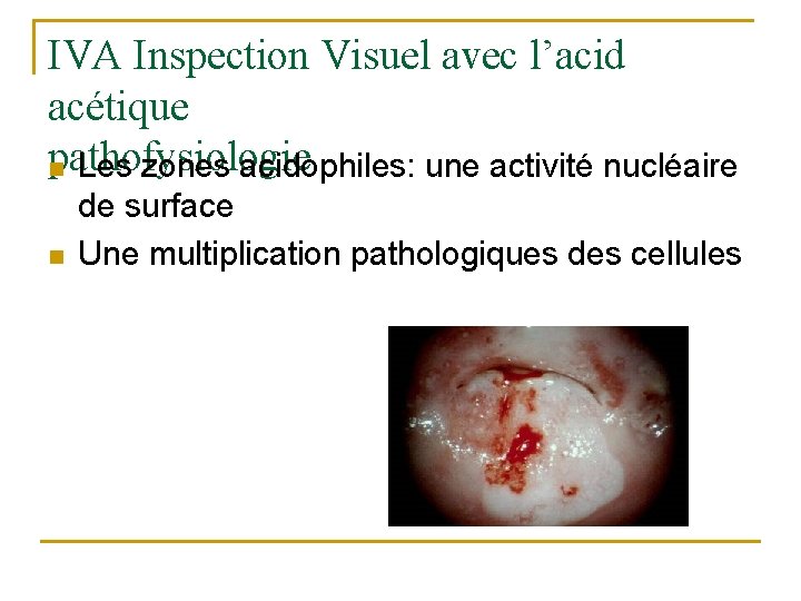 IVA Inspection Visuel avec l’acid acétique pathofysiologie n Les zones acidophiles: une activité nucléaire