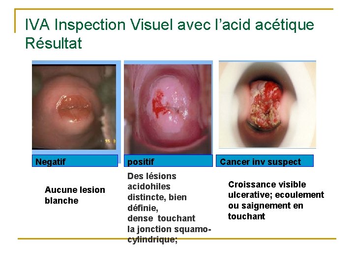 IVA Inspection Visuel avec l’acid acétique Résultat Negatif Aucune lesion blanche positif Des lésions