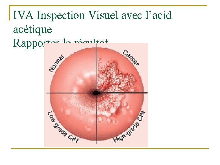 IVA Inspection Visuel avec l’acid acétique Rapporter le résultat 
