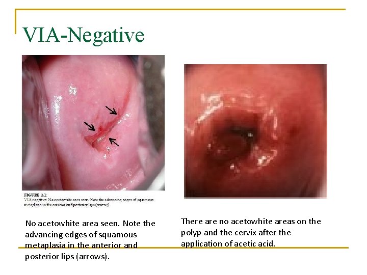 VIA-Negative No acetowhite area seen. Note the advancing edges of squamous metaplasia in the