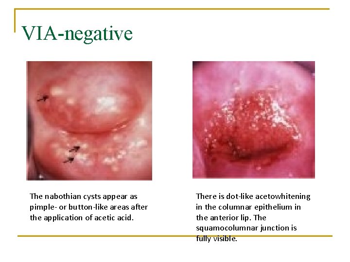 VIA-negative The nabothian cysts appear as pimple- or button-like areas after the application of