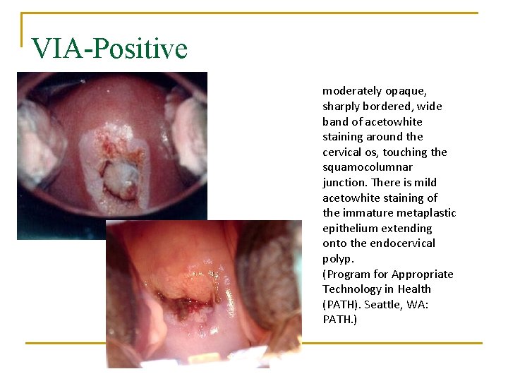VIA-Positive moderately opaque, sharply bordered, wide band of acetowhite staining around the cervical os,