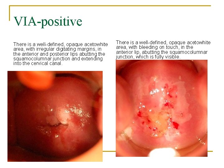 VIA-positive There is a well-defined, opaque acetowhite area, with irregular digitating margins, in the