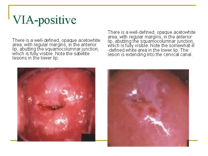 VIA-positive There is a well-defined, opaque acetowhite area, with regular margins, in the anterior
