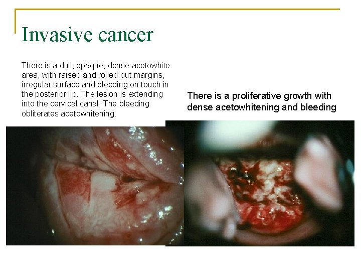Invasive cancer There is a dull, opaque, dense acetowhite area, with raised and rolled-out