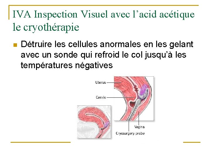 IVA Inspection Visuel avec l’acid acétique le cryothérapie n Détruire les cellules anormales en