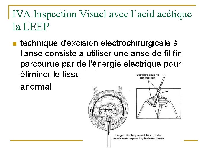IVA Inspection Visuel avec l’acid acétique la LEEP n technique d'excision électrochirurgicale à l'anse