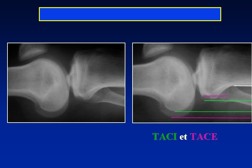  TACI et TACE 