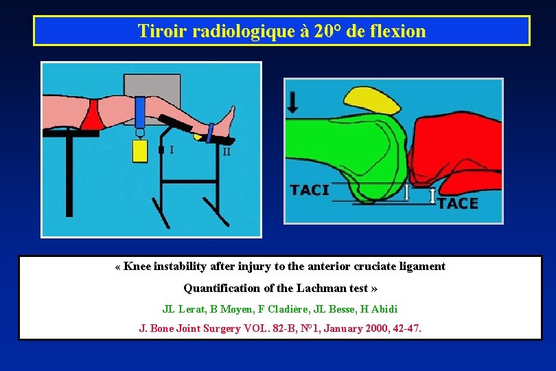 Tiroir radiologique à 20° de flexion « Knee instability after injury to the anterior