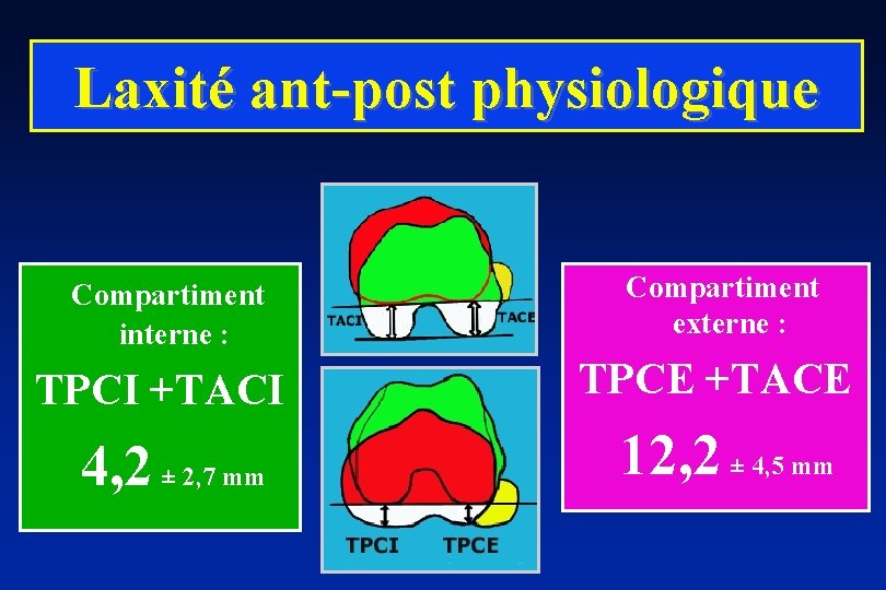 Laxité ant-post physiologique Compartiment interne : TPCI +TACI 4, 2 ± 2, 7 mm