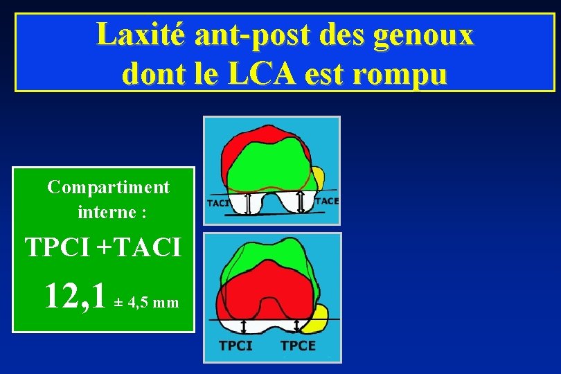 Laxité ant-post des genoux dont le LCA est rompu Compartiment interne : TPCI +TACI