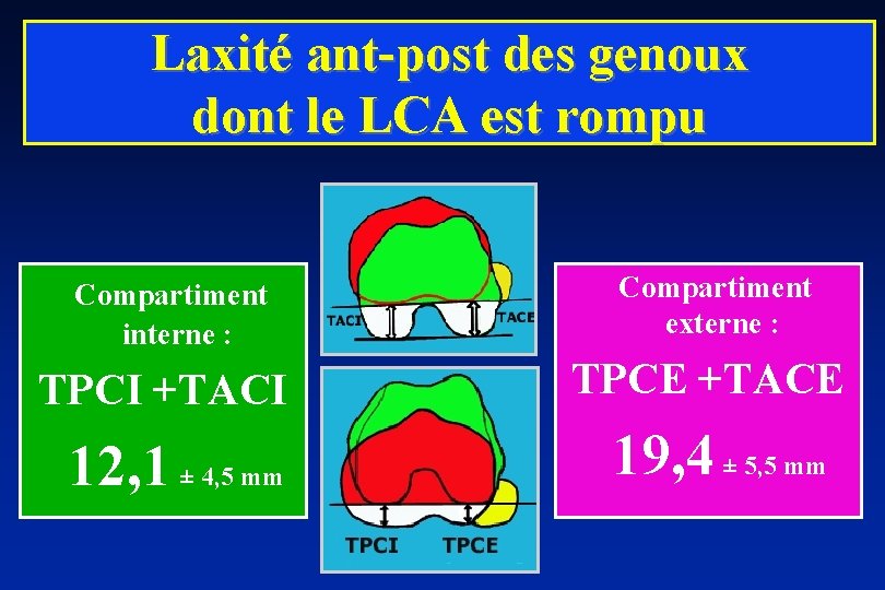 Laxité ant-post des genoux dont le LCA est rompu Compartiment interne : TPCI +TACI