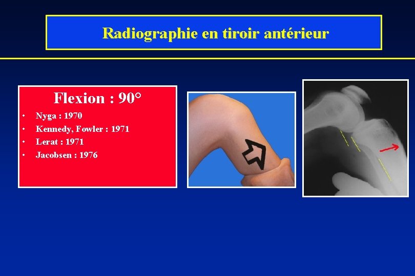  Radiographie en tiroir antérieur Flexion : 90° • • Nyga : 1970 Kennedy,