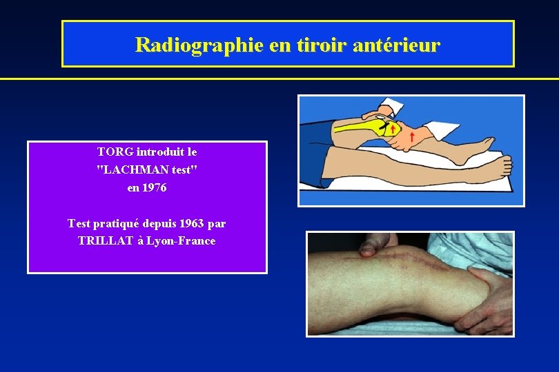 Radiographie en tiroir antérieur TORG introduit le "LACHMAN test" en 1976 Test pratiqué depuis