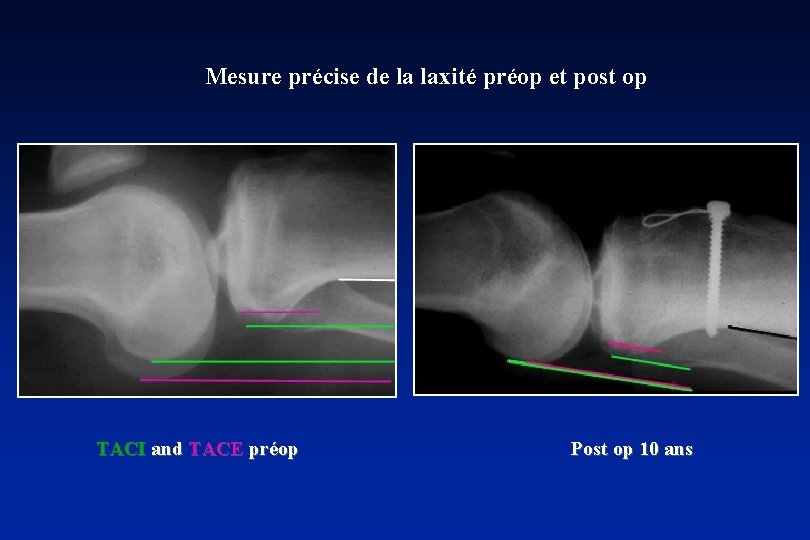 Mesure précise de la laxité préop et post op TACI and TACE préop Post