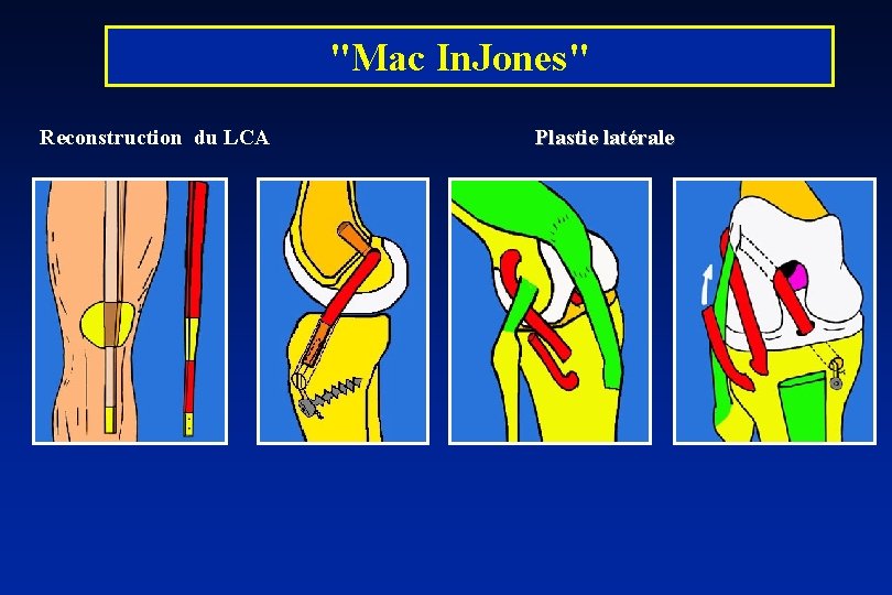 "Mac In. Jones" Reconstruction du LCA Plastie latérale 