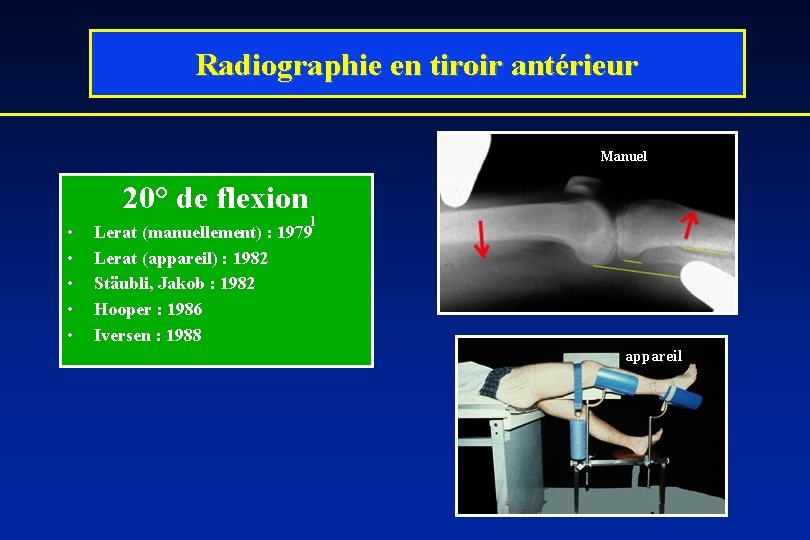 Radiographie en tiroir antérieur Manuel 20° de flexion • • • l Lerat (manuellement)