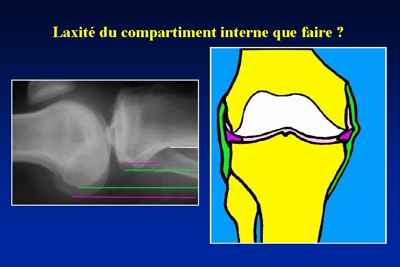 Laxité du compartiment interne que faire ? 