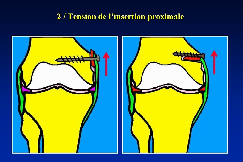 2 / Tension de l’insertion proximale 