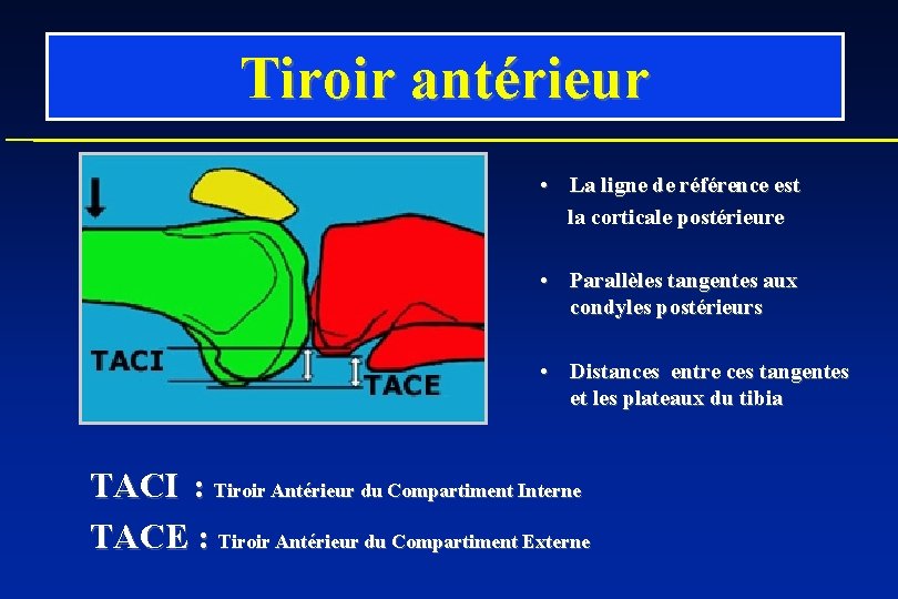 Tiroir antérieur • La ligne de référence est la corticale postérieure • Parallèles tangentes