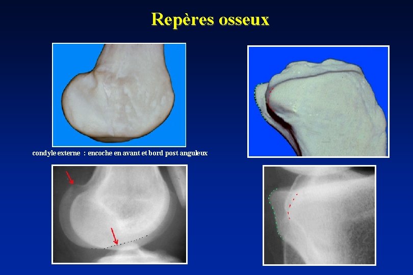 Repères osseux condyle externe : encoche en avant et bord post anguleux 