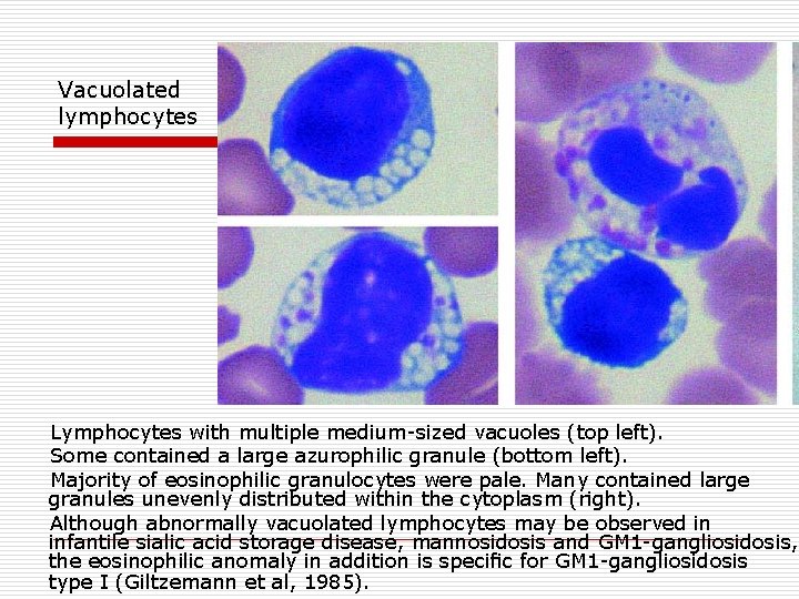 Vacuolated lymphocytes Lymphocytes with multiple medium sized vacuoles (top left). Some contained a large