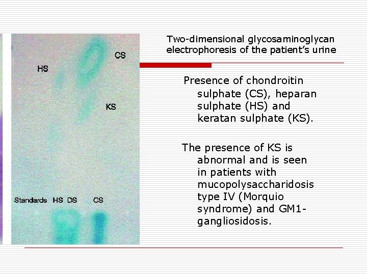 Two dimensional glycosaminoglycan electrophoresis of the patient’s urine Presence of chondroitin sulphate (CS), heparan