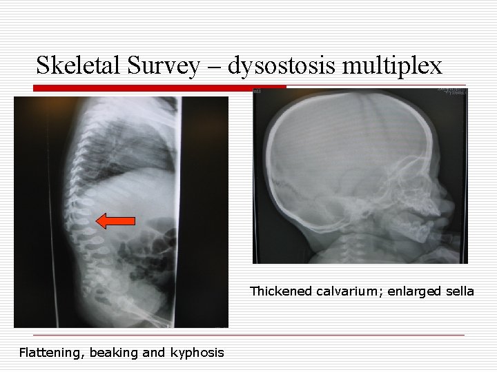 Skeletal Survey – dysostosis multiplex Thickened calvarium; enlarged sella Flattening, beaking and kyphosis 