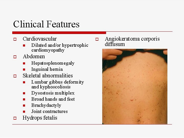 Clinical Features o Cardiovascular n o Abdomen n n o Hepatosplenomegaly Inguinal hernia Skeletal