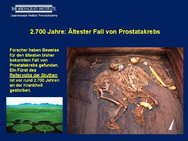 Laparoscopic Radical Prostatectomy 2. 700 Jahre: Ältester Fall von Prostatakrebs Forscher haben Beweise für