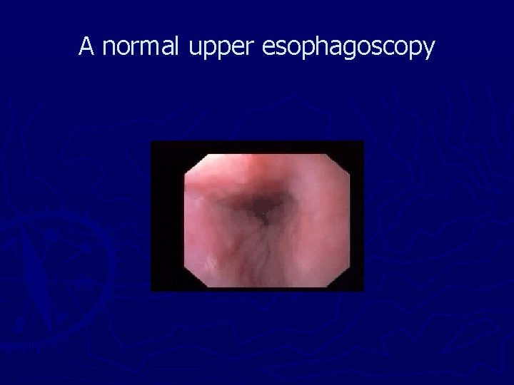 A normal upper esophagoscopy 