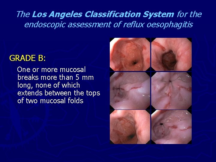 The Los Angeles Classification System for the endoscopic assessment of reflux oesophagitis GRADE B: