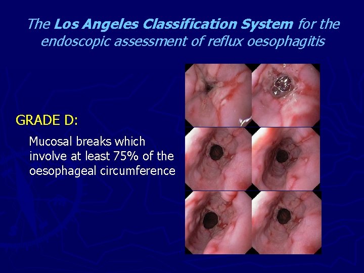 The Los Angeles Classification System for the endoscopic assessment of reflux oesophagitis GRADE D: