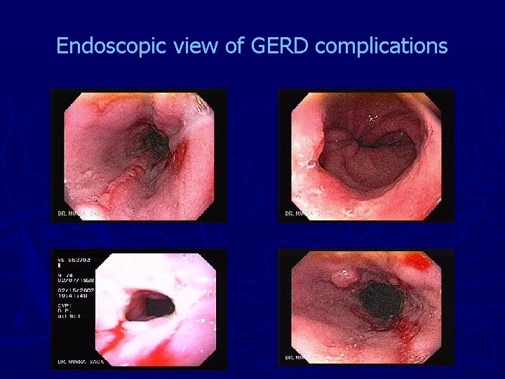 Endoscopic view of GERD complications 