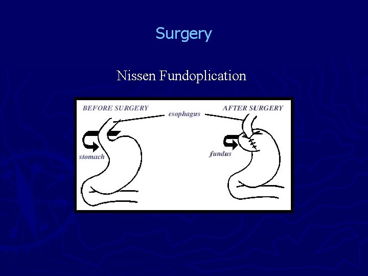 Surgery Nissen Fundoplication 