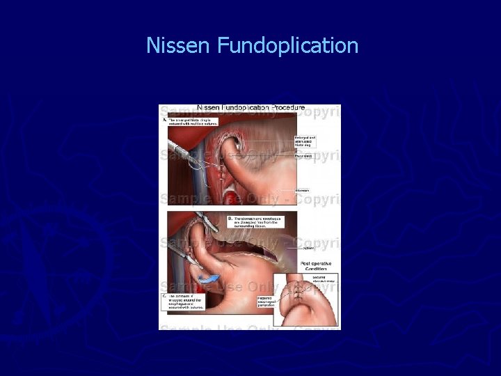 Nissen Fundoplication 