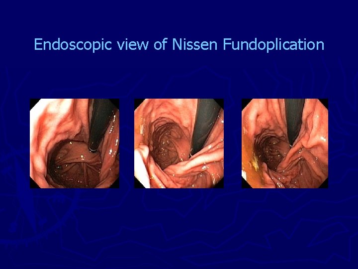 Endoscopic view of Nissen Fundoplication 