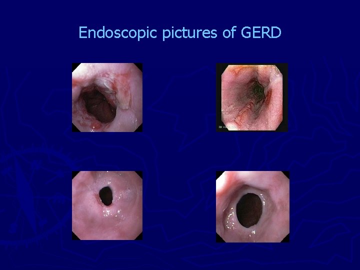 Endoscopic pictures of GERD 