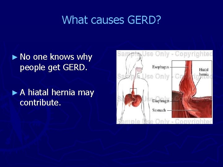 What causes GERD? ► No one knows why people get GERD. ►A hiatal hernia
