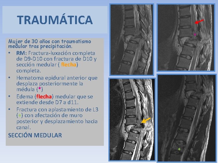 TRAUMÁTICA * Mujer de 30 años con traumatismo medular tras precipitación. • RM: Fractura-luxación