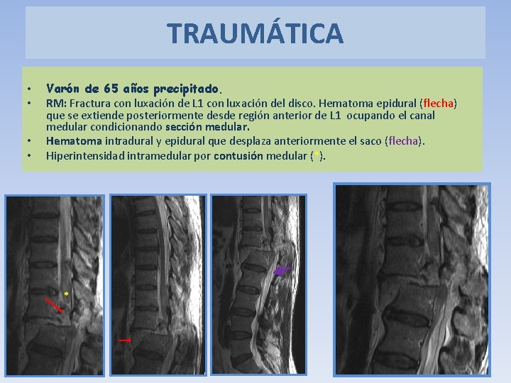 TRAUMÁTICA • • Varón de 65 años precipitado. RM: Fractura con luxación de L