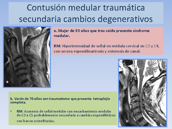 Contusión medular traumática secundaria cambios degenerativos a. Mujer de 93 años que tras caída